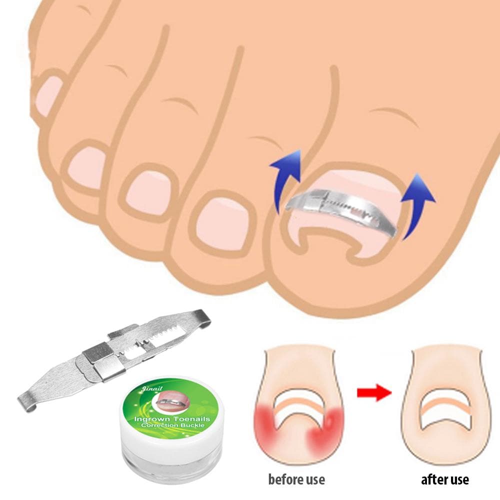 Corretor de unha encravada ferramenta de tratamento de correção de unha ferramenta de cuidados com as unhas ortopédicas prata